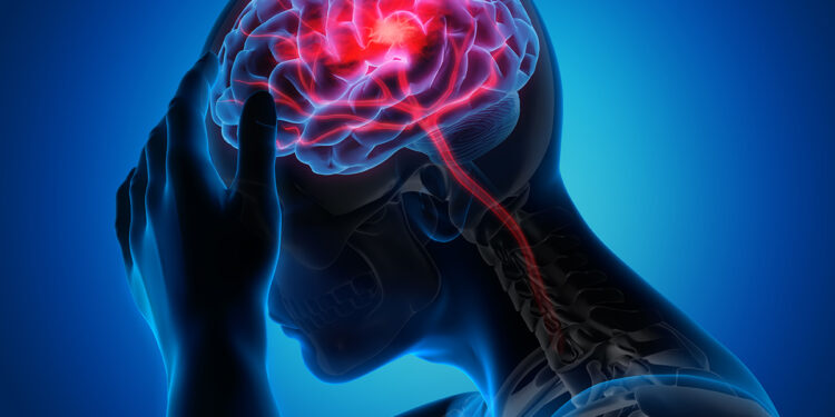 What Is a Mild Stroke? Signs, Risk Factors, and Treatments